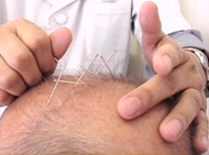 Acupuncture